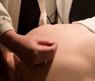 Acupuncture needles are placed on the back of a patient lying face down.